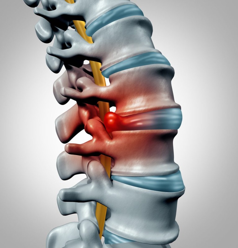 Cervical and Lumbar Disc Prolapse