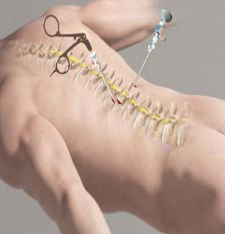 Micro Endoscopic Minimally Invasive Spine Surgery