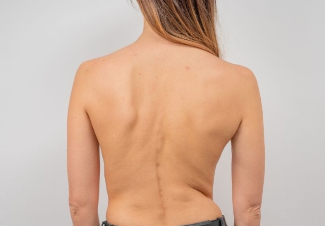 Scoliosis