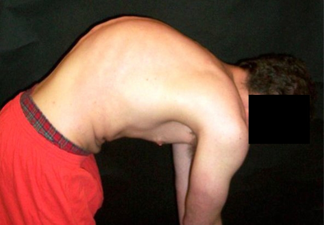 Kyphosis (Excessive Forward Curve)