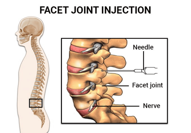 Facet Joint Injections