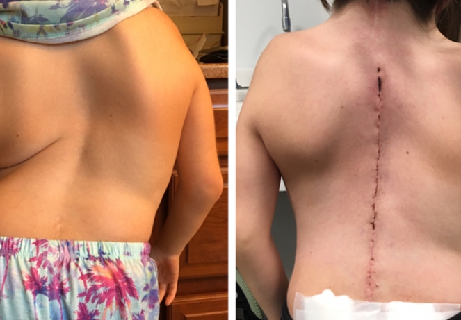 Adolescent Idiopathic Scoliosis