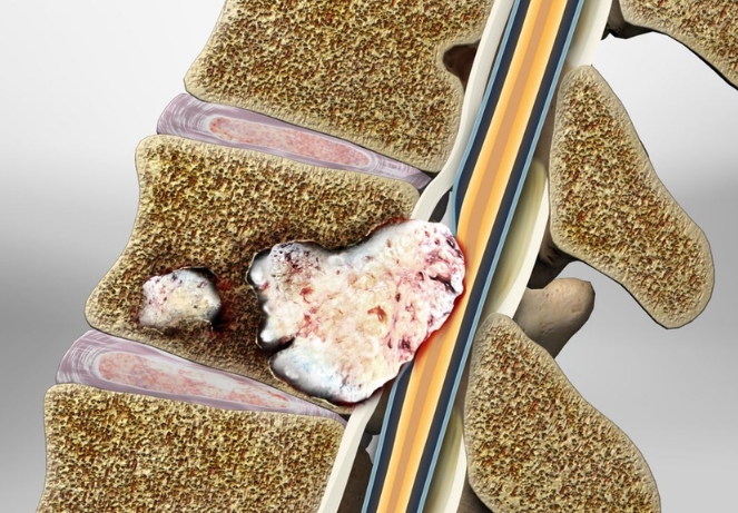 Malignant Spine Tumors