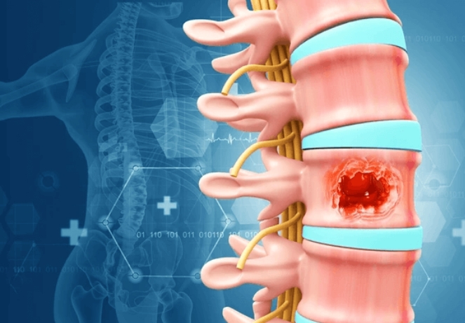 benign spine tumor