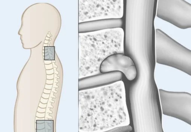 Primary Spine Tumors