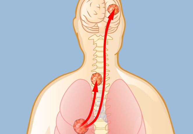 Metastatic Spine Tumors