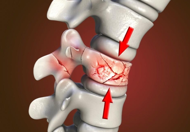 Compression Fracture