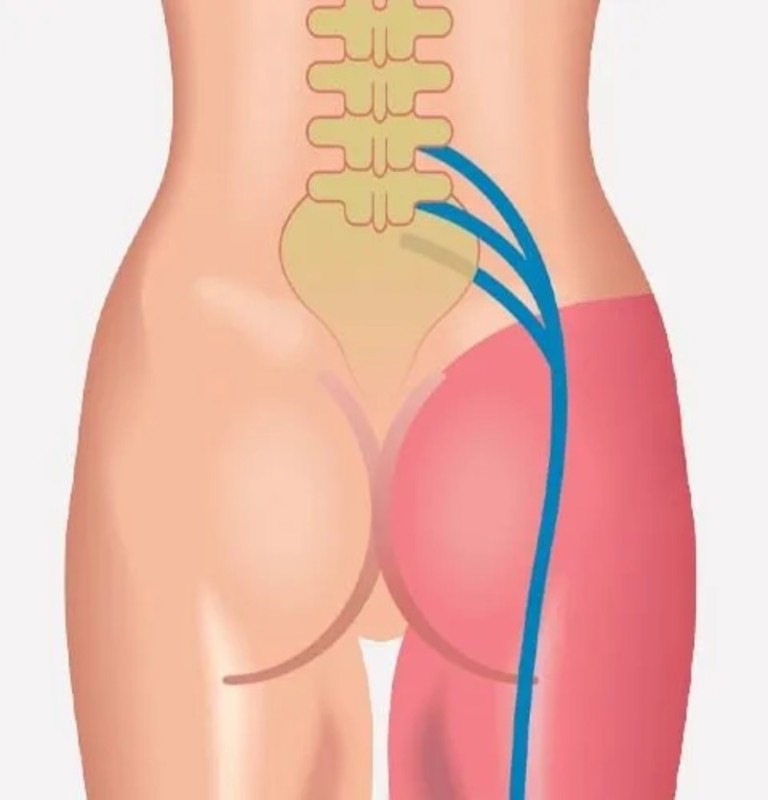 Sciatica